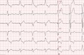 Half of TAVR Patients Develop Potentially Dangerous Conduction Abnormalities